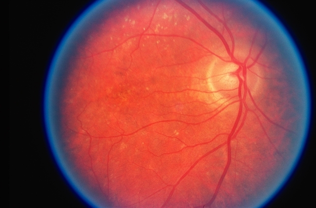 Хороидеремия