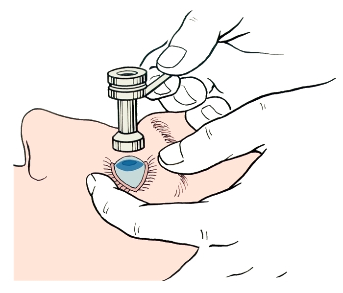 Тонометрия по Маклакову