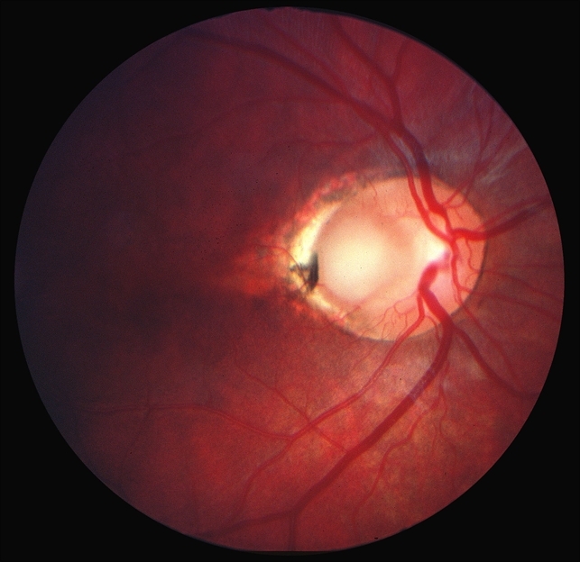 Ямка диска зрительного нерва