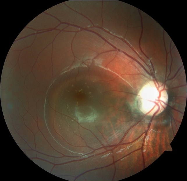 Длительно существующая отслойка сетчатки при ямке ДЗН