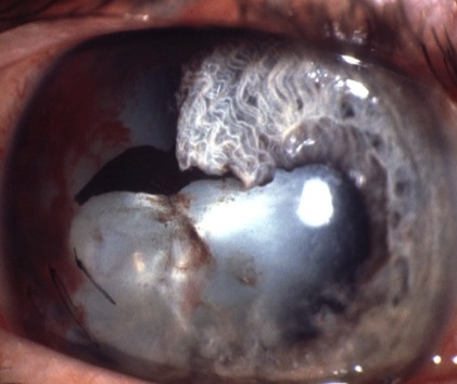 Травматическая катаракта