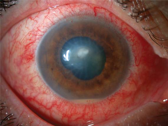 Ползучая язва роговицы