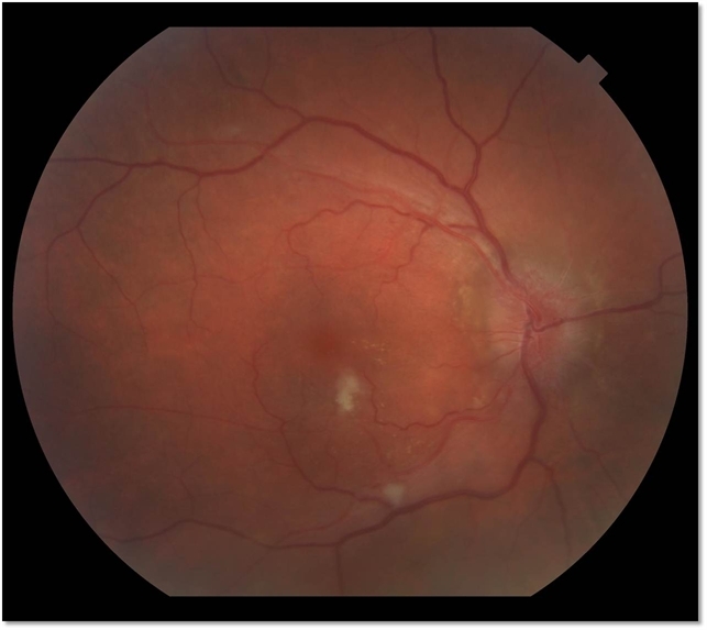 Застойный диск зрительного нерва