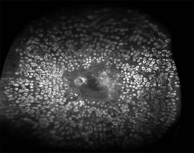 Панретинальная лазерная коагуляция