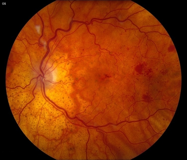 Диабетическая ретинопатия