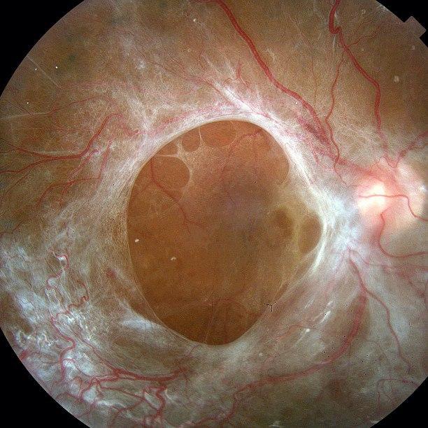 Пролиферативная диабетическая ретинопатия