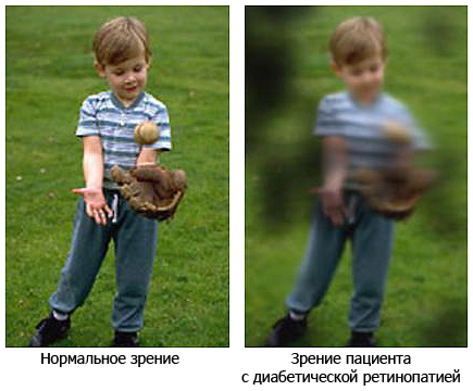 Как видит человек с диабетической ретинопатией?