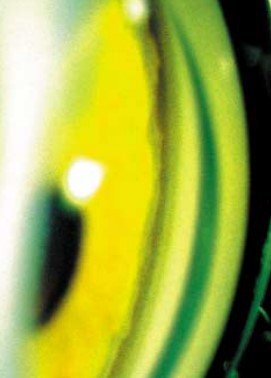 Фрагмент угла передней камеры правого глаза б-ной Д.