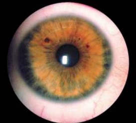 Радужка правого глаза б-ной Д.