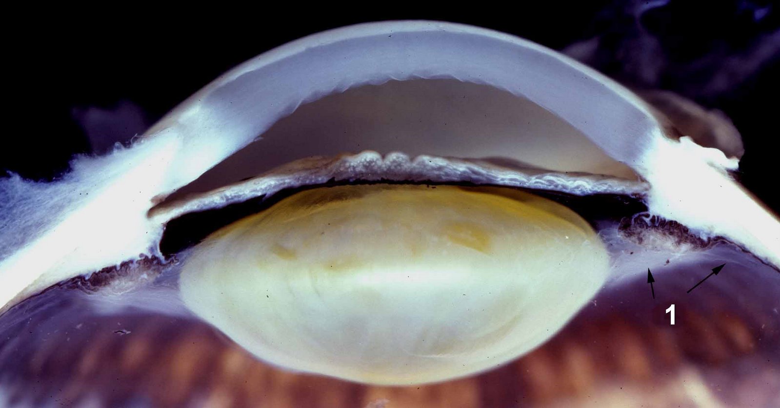 Псевдоэксфолиативный синдром