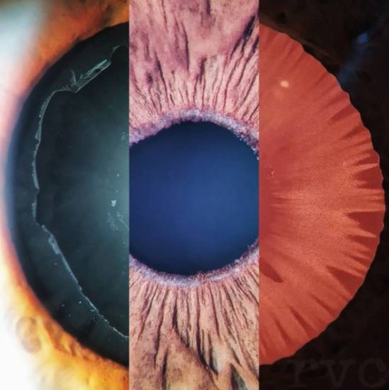 Псевдоэксфолиативный синдром