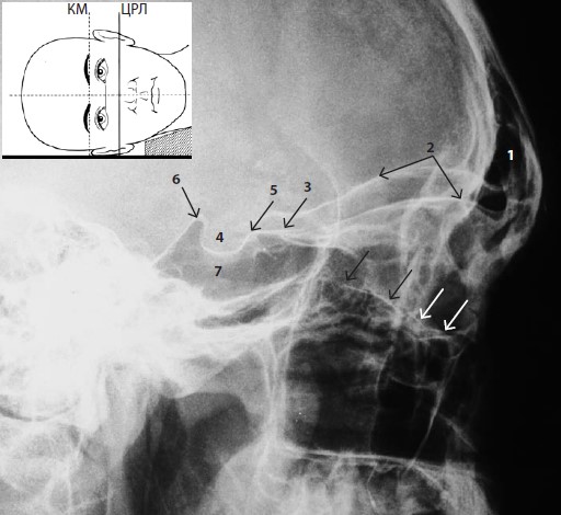 Рентгенограмма черепа в боковой проекции