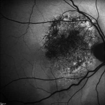 Меланома хороидеи