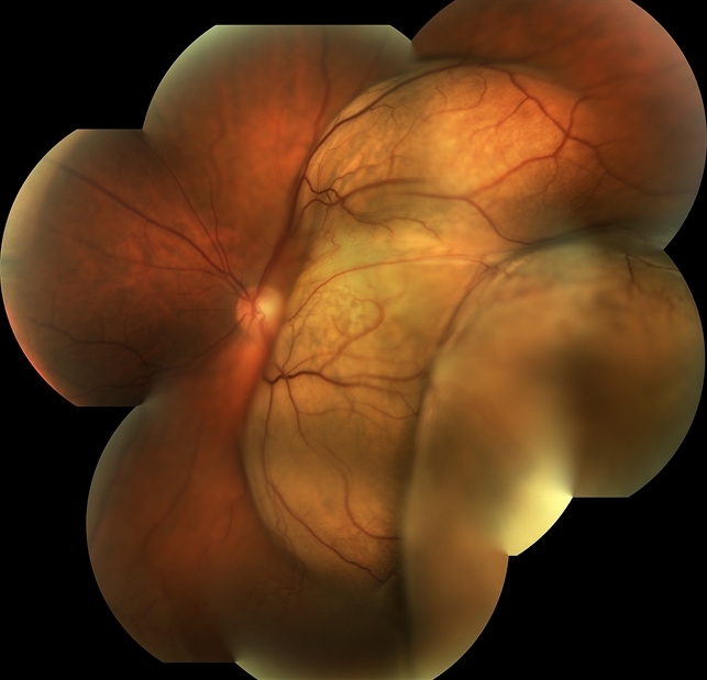 Беспигментная меланома хороидеи