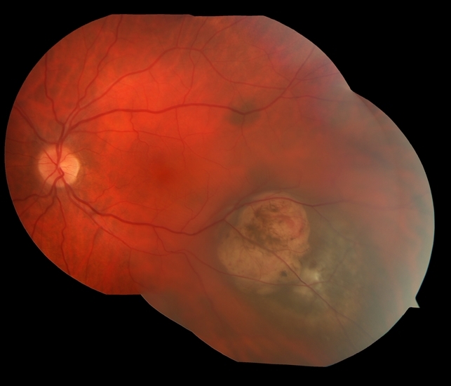 Меланома хороидеи