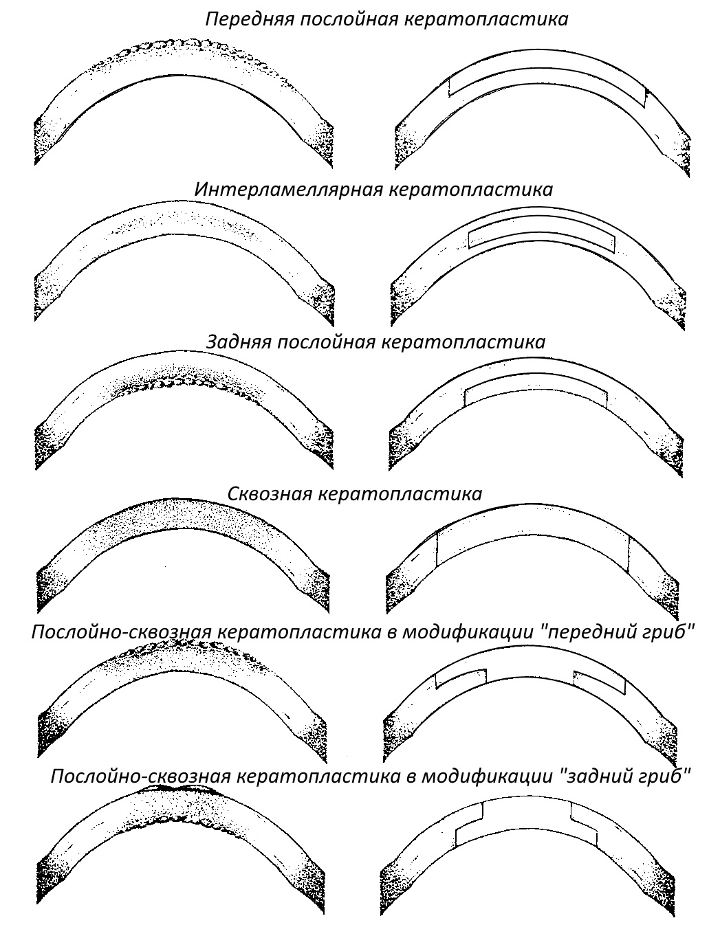 Виды кератопластик