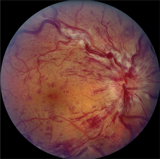 Окклюзия центральной вены сетчатки