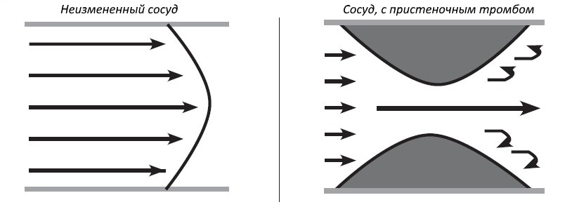 Характер потока крови в различных условиях сосудистого русла