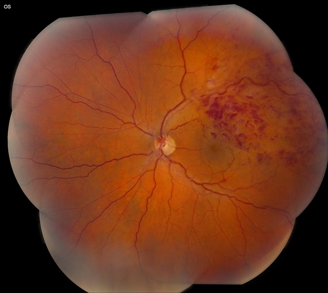 Окклюзия ветви ЦВС