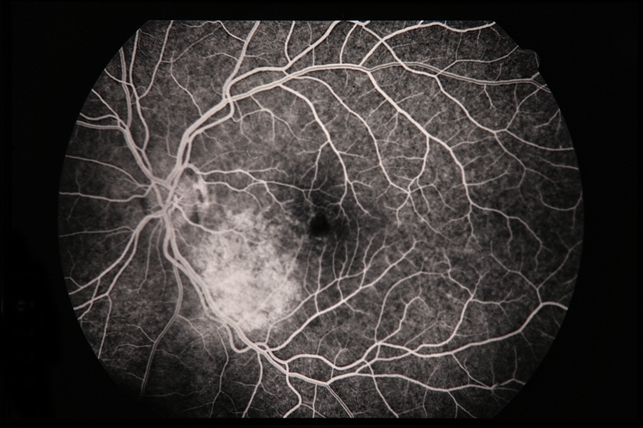 Гемангиома хороидеи