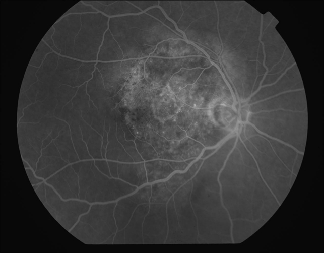 ФАГ при меланоме хороидеи