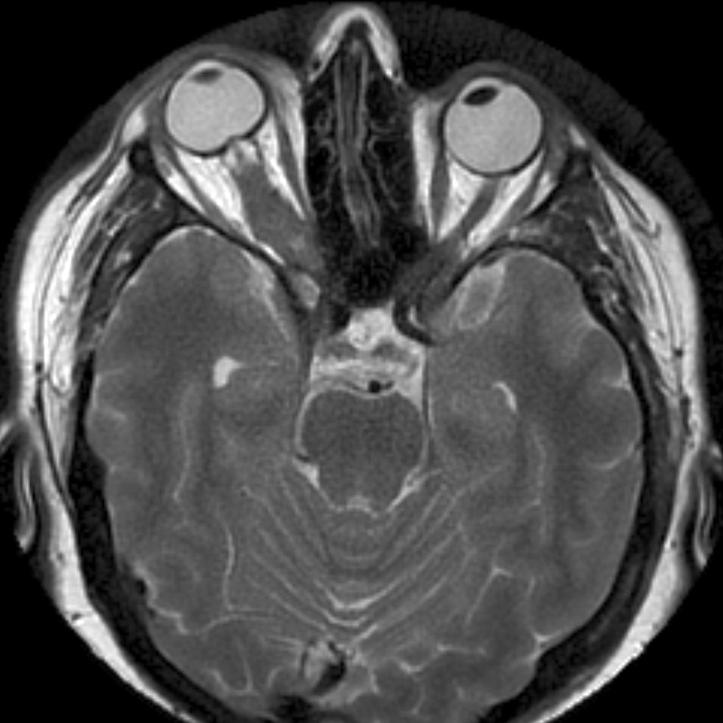 Менингиома зрительного нерва