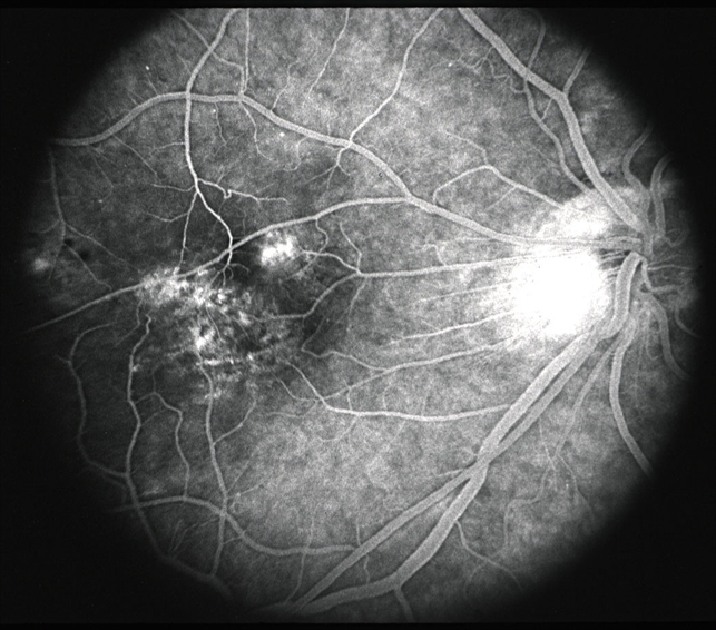 Макулярный отёк