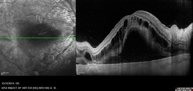 ОКТ при макулярном отёке