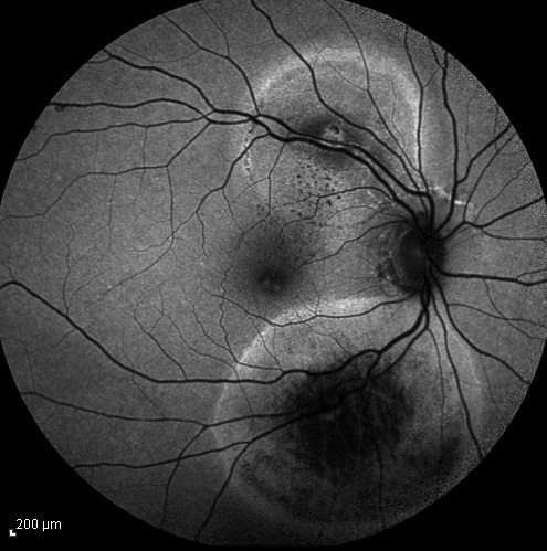 2 артериальные макроаневризмы различной давности.