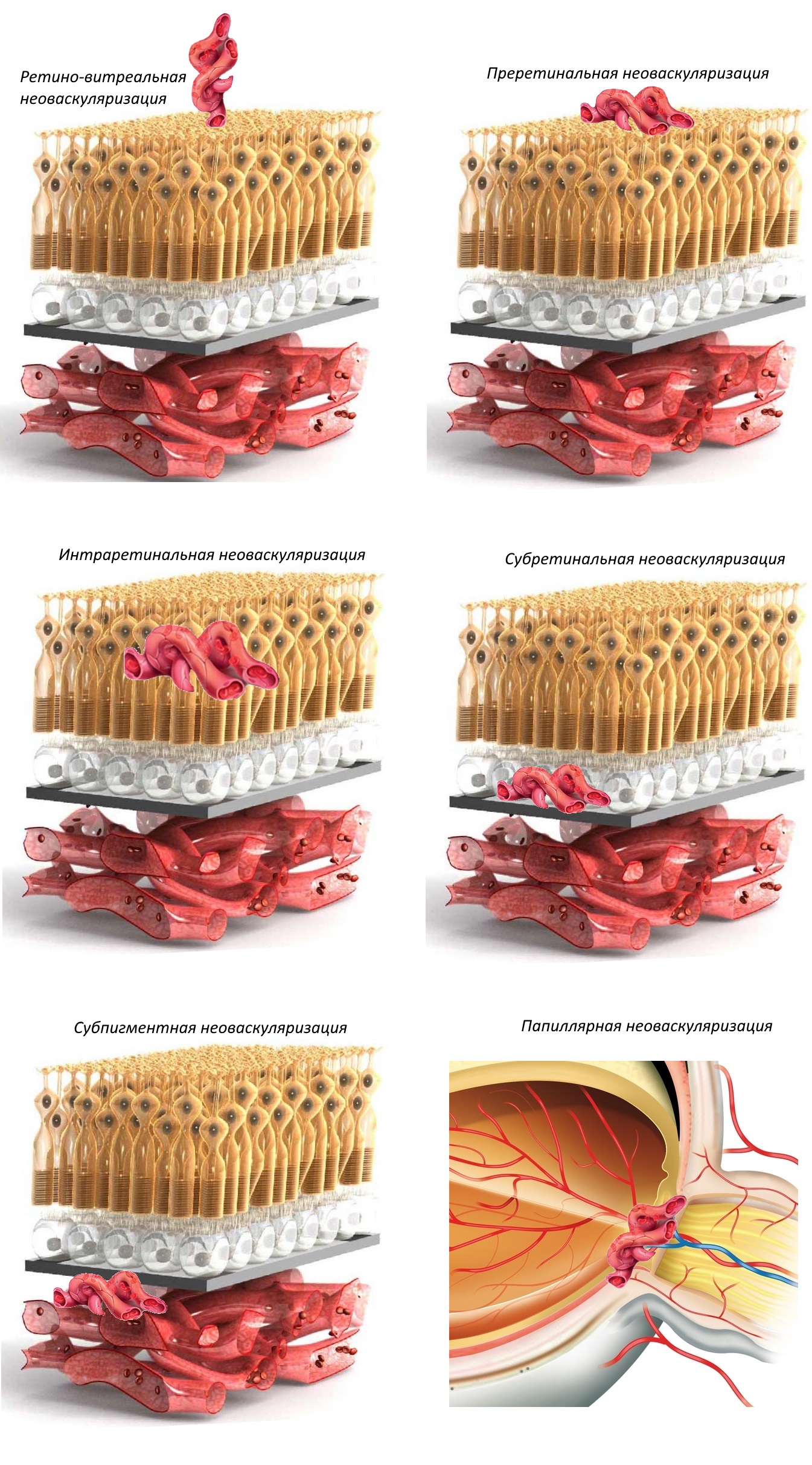 Виды неоваскуляризации