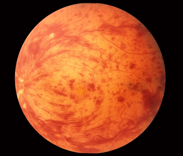 Интраретинальные геморрагии