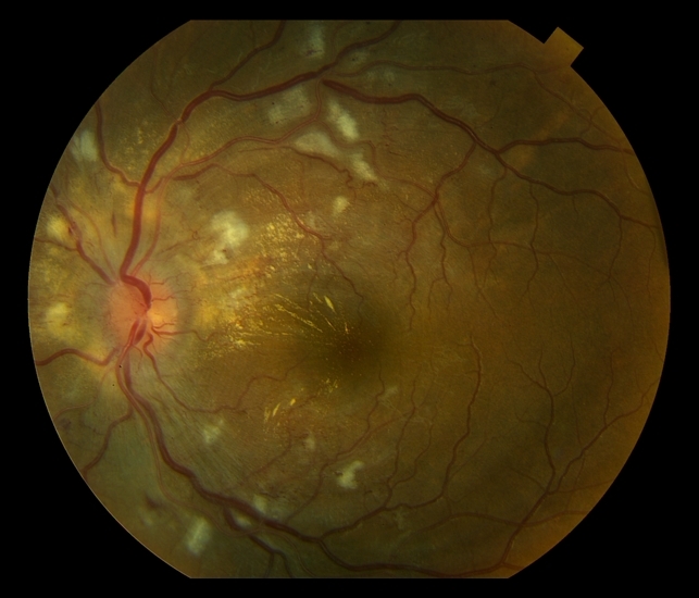 Гипертензивная ретинопатия:макулярный отек, ишемия макулы, оптическая нейропатия, ватообразные очаги мягкого экссудата