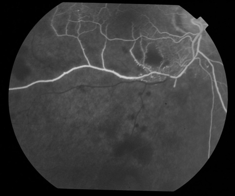 Флуоресцентная ангиограмма правого глаза пациента с окклюзией нижневисочной ветви центральной вены сетчатки, демонстрирующая задержку заполнения капилляров и неперфузируемую зону в пострадавшем квадранте.