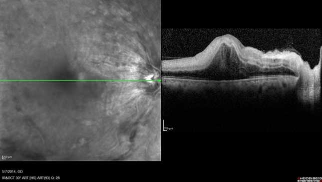 ОКТ сетчатки при тромбозе ЦАС и ЦВС