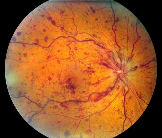 Окклюзия центральной вены сетчатки, неишемический тип