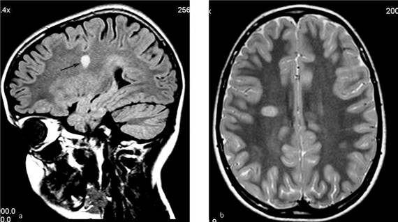 Очаги в головном мозге при рассеянном склерозе