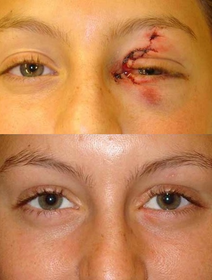 Ранение века до и после операции