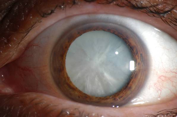 Зрелая катаракта