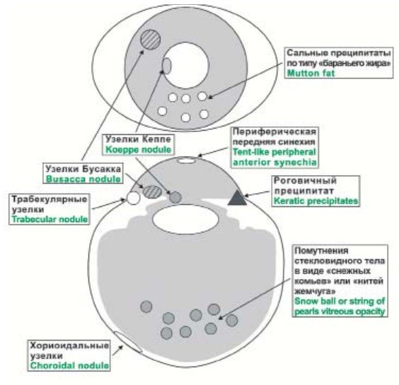 Внутриглазные проявления саркоидоза