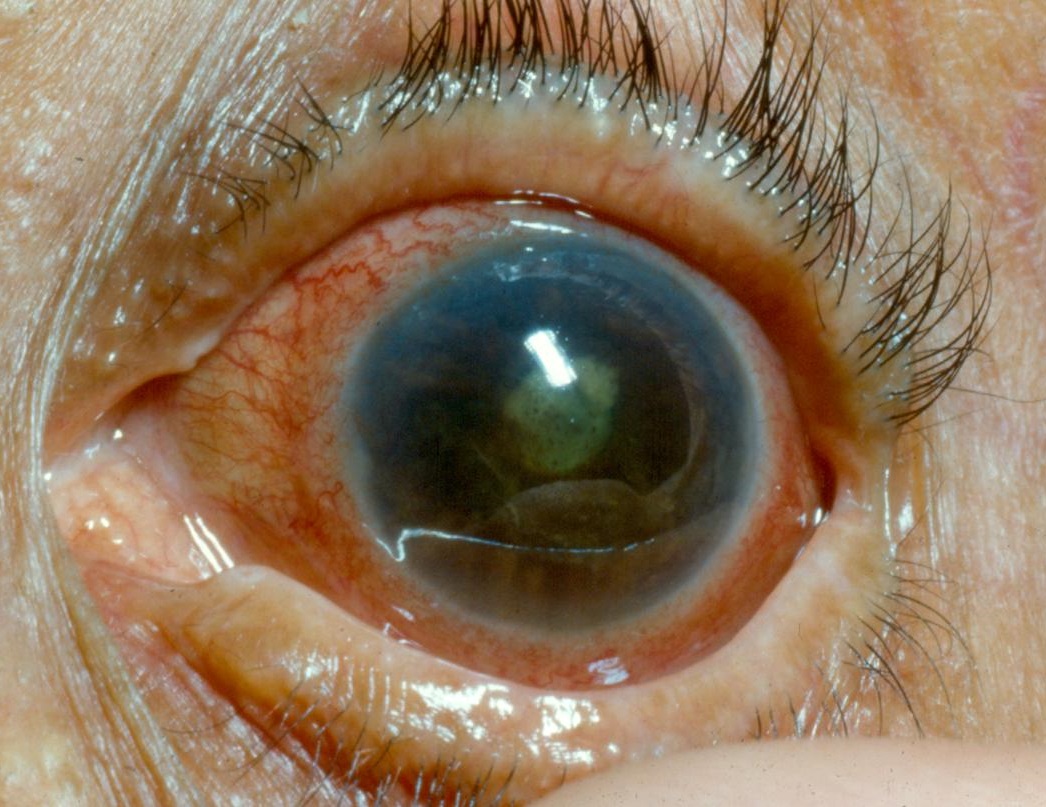 Факогенная глаукома