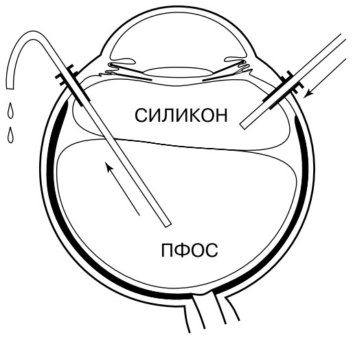 Замена ПФОС на силиконовое масло