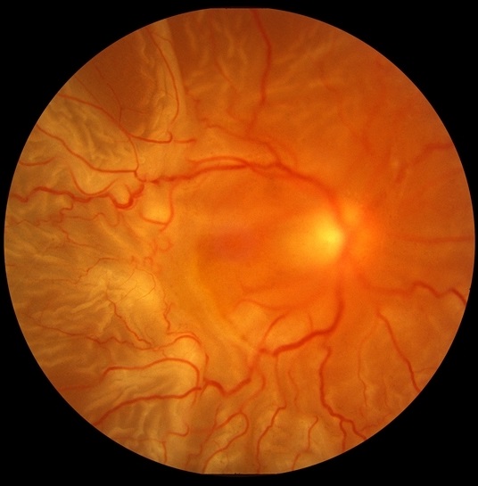 Пролиферативная витреоретинопатия