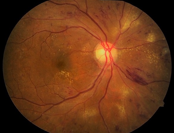 Диабетический макулярный отёк