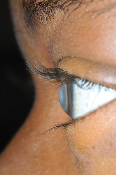 Острый кератоконус