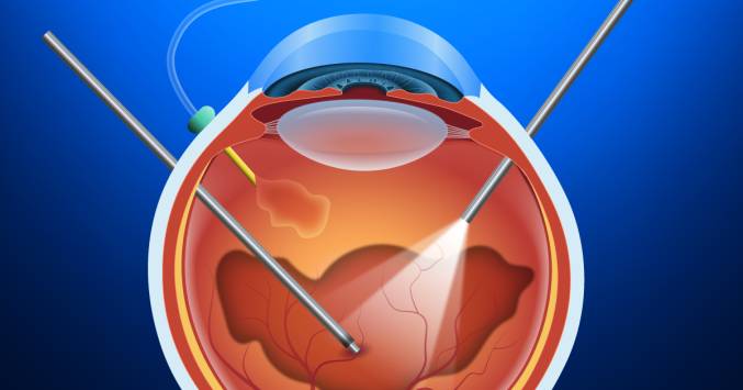 Витрэктомия