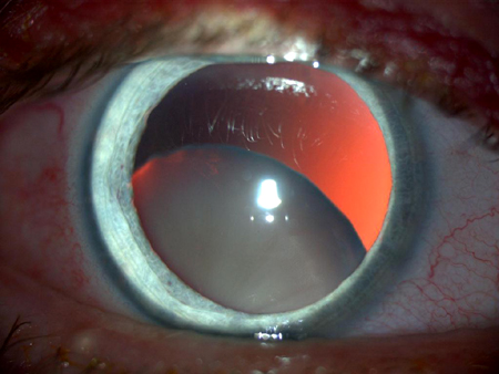 Подвывих хрусталика 3 степени