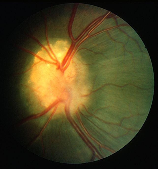 Друзы зрительного нерва