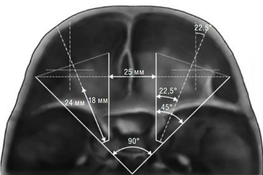 Аксиальный срез глазниц