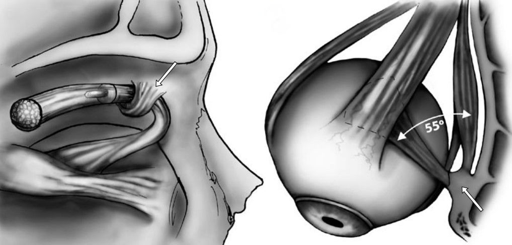 Анатомия блока. Передне-латеральная и верхняя проекции . Стрелкой указан блок