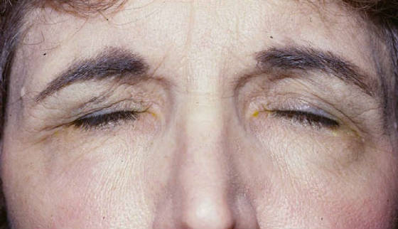 Блефароспазм